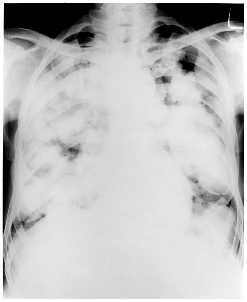 WHO Report Says Tuberculosis Screening and Preventive Treatment Can Deliver Strong Returns